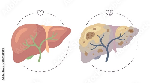 Healthy and Unhealthy Liver Comparison Medical Illustration