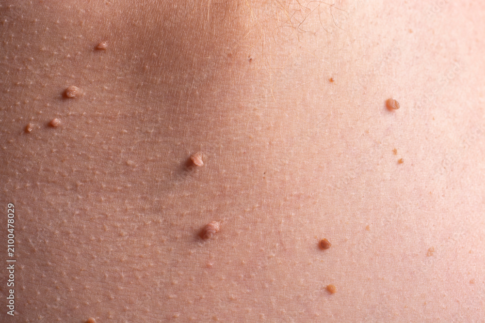 Fototapeta premium Close-up of papillomas on the human body