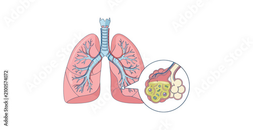 Human Lungs Pneumonia Infection Medical Illustration