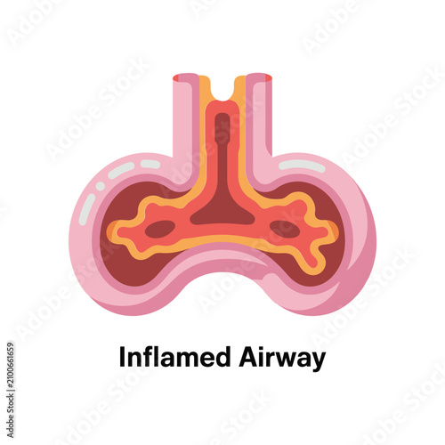 Photos Inflamed airway anatomy showing respiratory inflammation and bronchial constrict