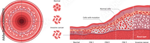 Fotografie Cervical Cancer Progression Diagram Showing Normal Cells to Invasive Cancer Keyw