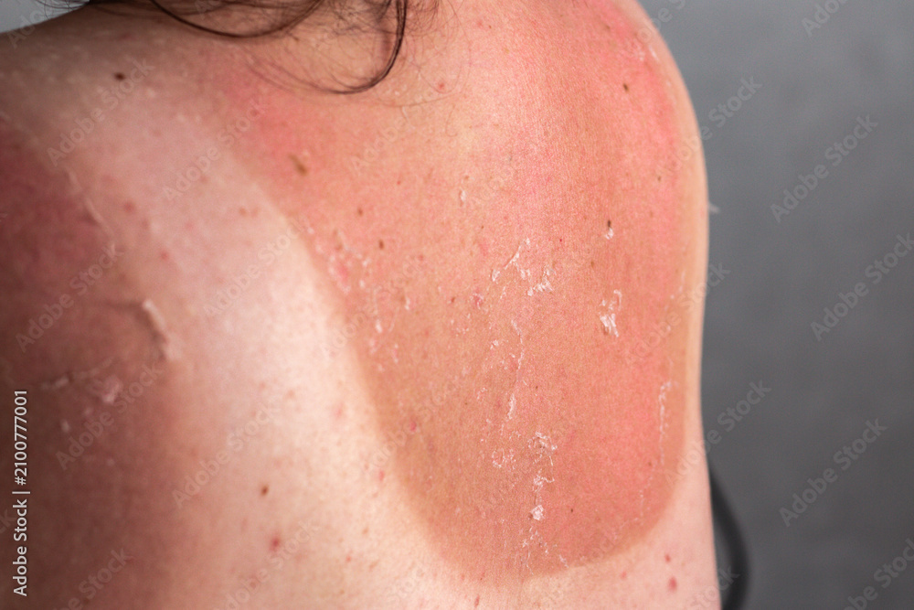 Fototapeta premium Woman with peeling shoulders and back from excessive sun. Skin regeneration after burn. Close up of redness