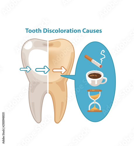 Tooth Discoloration Causes