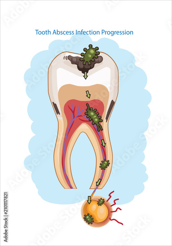 Tooth Abscess Infection Progression Cartoon Illustration