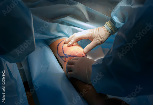 Photography cosmetic liposuction surgery in actual operating room setting showing surgeon ha