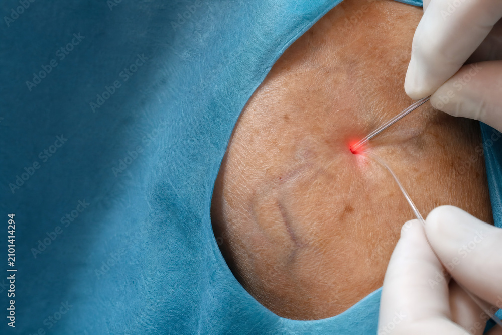 Fototapeta premium Endovenous Laser Ablation Procedure for Varicose Veins