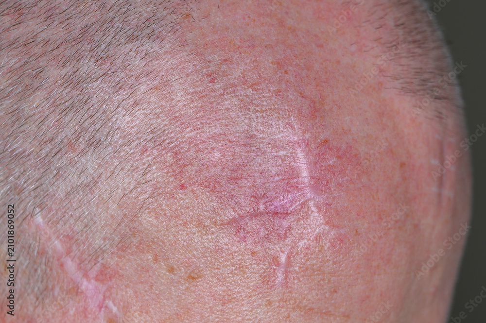 Fototapeta premium Close-up of a scalp with short hair and multiple visible scars on the skin