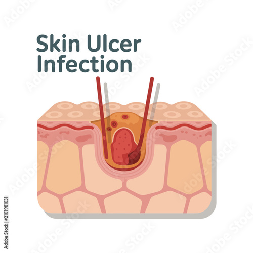 Photography Skin ulcer infection diagram showing a cross section of human dermis with inflam