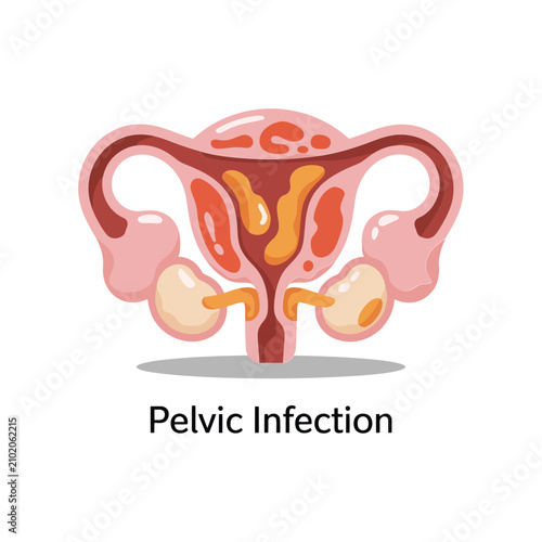 фотографія Anatomical of female reproductive system showing pelvic infection with inflamed