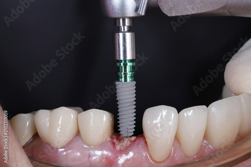 Close up of dentist hand installing titanium dental implant fixture into bone graft jaw with drill tool.