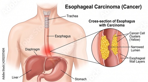 Medical illustration of esophageal carcinoma with tumor cross section
