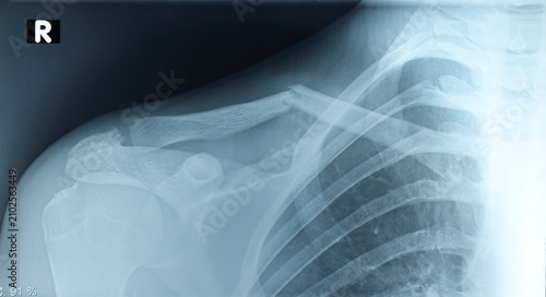 Obraz na płótnie Frontal X-ray of young female cyclist showing displaced collarbone fracture after cycling fall