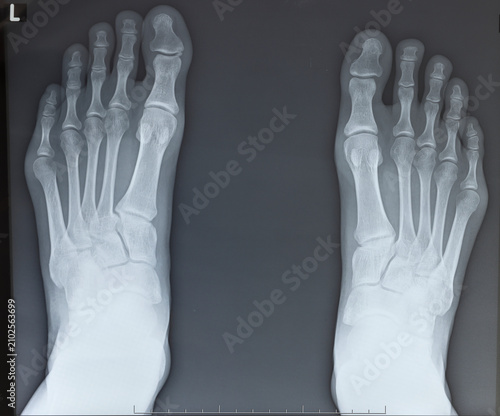 Photos Anteroposterior X-ray of bilateral feet from young female patient, where small t