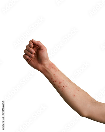  human forearm with realistic minor skin redness and insect bite marks