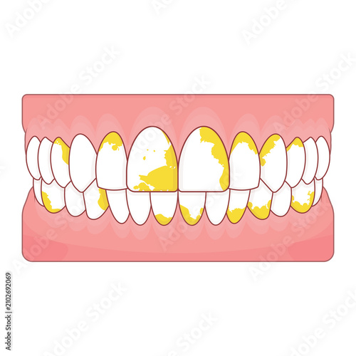 фотографія Tartar buildup on teeth illustration cartoon cute