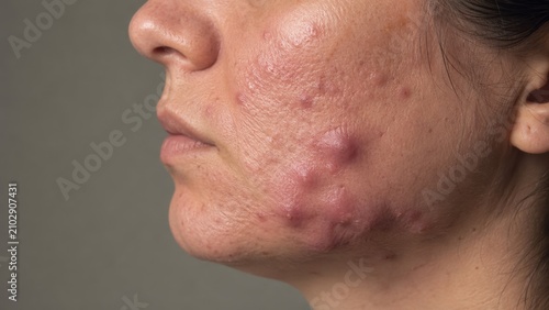 Close-up of female cheek with inflamed skin and severe acne pimples and scars