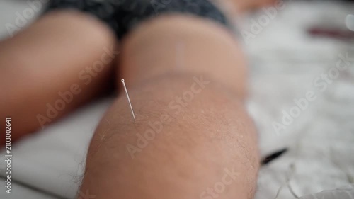 A man is receiving an acupuncture treatment in a serene bedroom setting, featuring white bedding. The video captures a close-up, top-down perspective of the acupuncture bed.