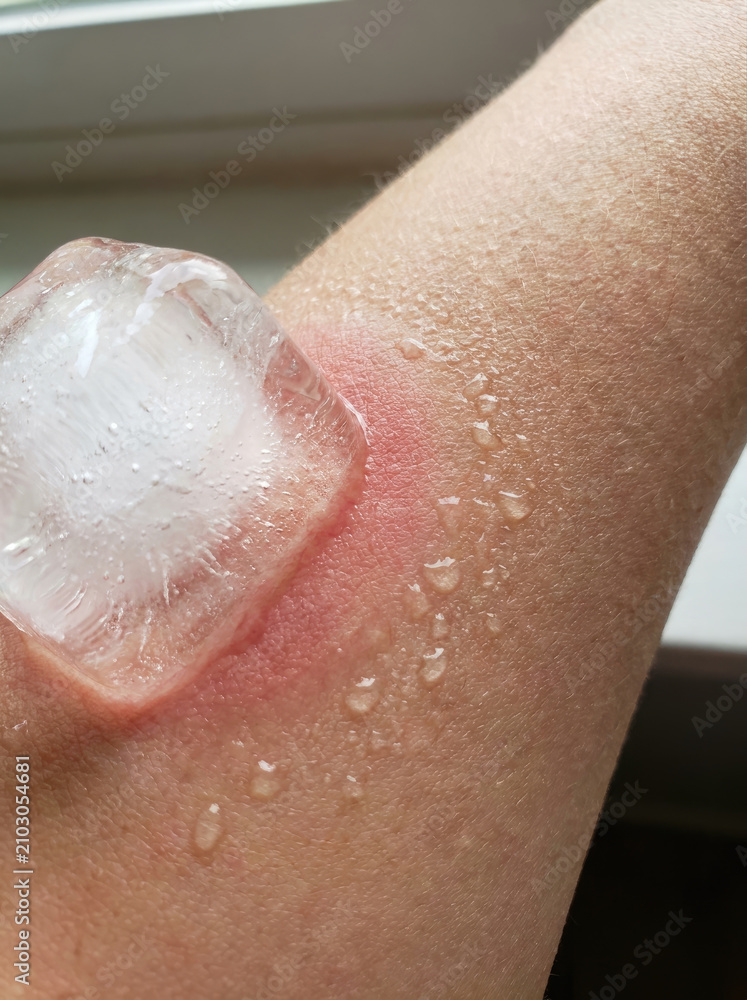 Fototapeta premium Ice cube contact on warm arm shows condensation and redness