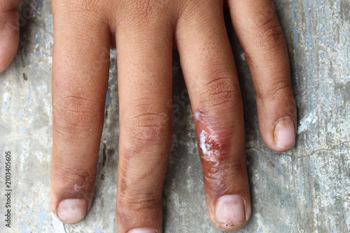 Burns on children's fingers with white medicated ointment