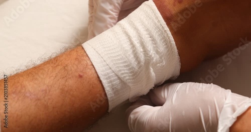 Doctor's gloved hands removing a bandage to examine and clean a severe skin rash on a patient's leg
