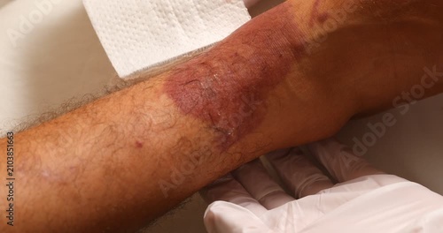 Close-up shot of a medical professional or nurse wearing white latex gloves. They carefully remove a white gauze bandage from a patient's lower leg, revealing a large, dark red skin lesion