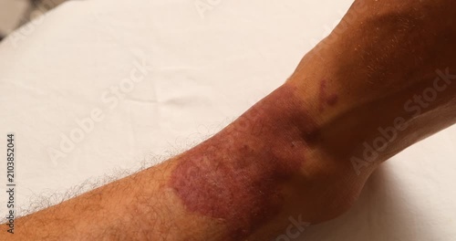Slow camera pan revealing a severe red skin rash or allergic reaction on a patient's leg
