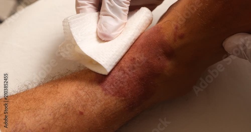 Doctor's gloved hands cleaning and wiping a severe red skin rash on a patient's leg