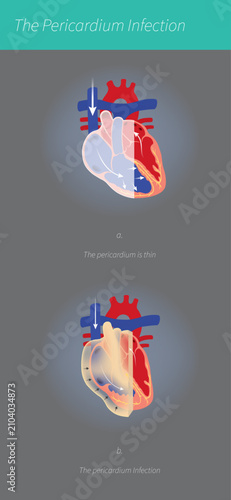 Foto Pericardium Infection Medical Diagram