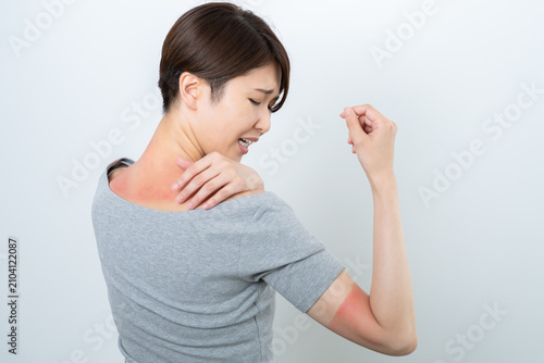 赤く日焼けする女性