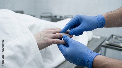 Medical examiner inspecting toxicological petechial hemorrhages on dead body fingers close up
