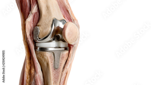 Total knee replacement with tibial baseplate implant in a photorealistic anatomical cutaway of the knee joint on white background for orthopedic surgery, healthcare, and patient education