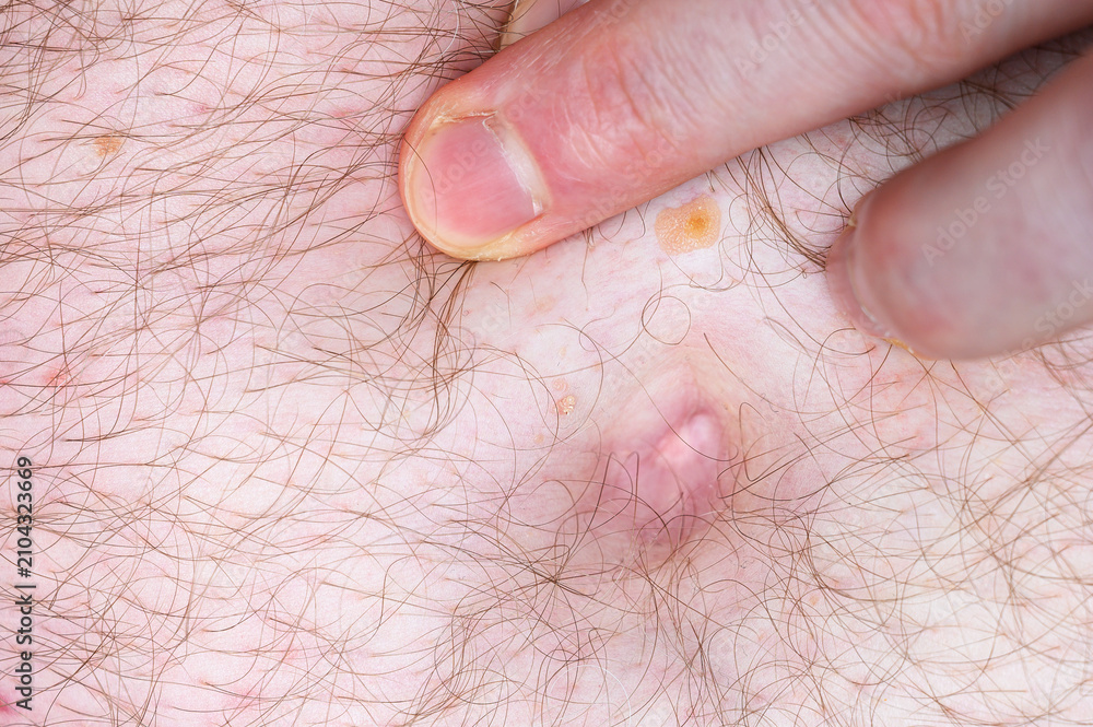 Fototapeta premium Finger pressing on hairy skin revealing a bump and yellowish scaly patches