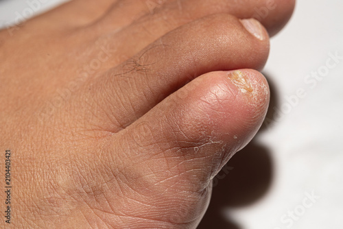 Close-up of a human foot showing severe toenail fungus and dry skin on the small toe