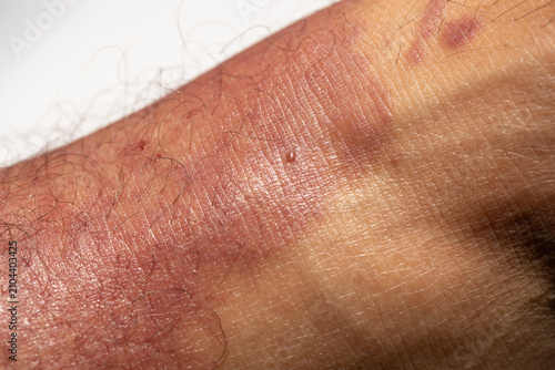 фотографія Extreme macro detail of inflamed red skin with severe allergic reaction or derma