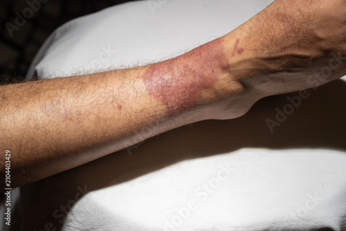  Close-up of a severe red skin rash and swelling on a patient's lower leg