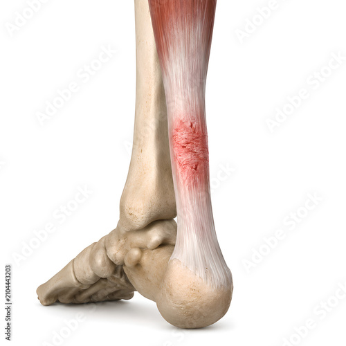 Achilles tendinopathy with partial tendon microtears in isolated 3D ankle anatomy render showing damaged fibers and heel attachment for medical education, healthcare design, and patient information