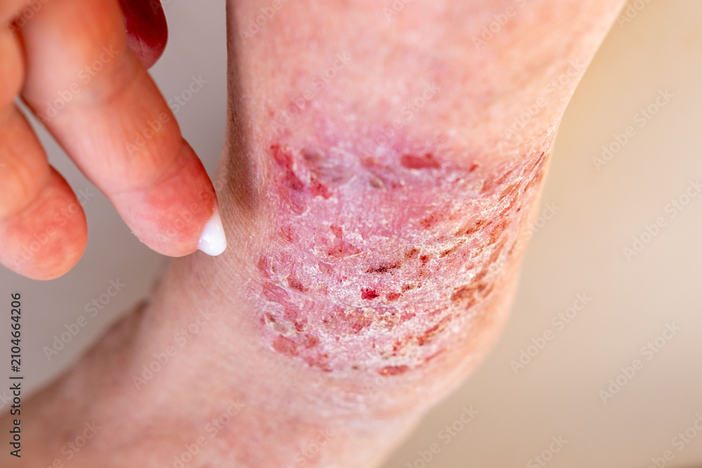 Fototapeta premium doctor treats large healing wound from lower leg with scars adult female patient, redness, diabetes disease, scarring skin, medical care, human tissue regeneration, hives and other skin manifestations