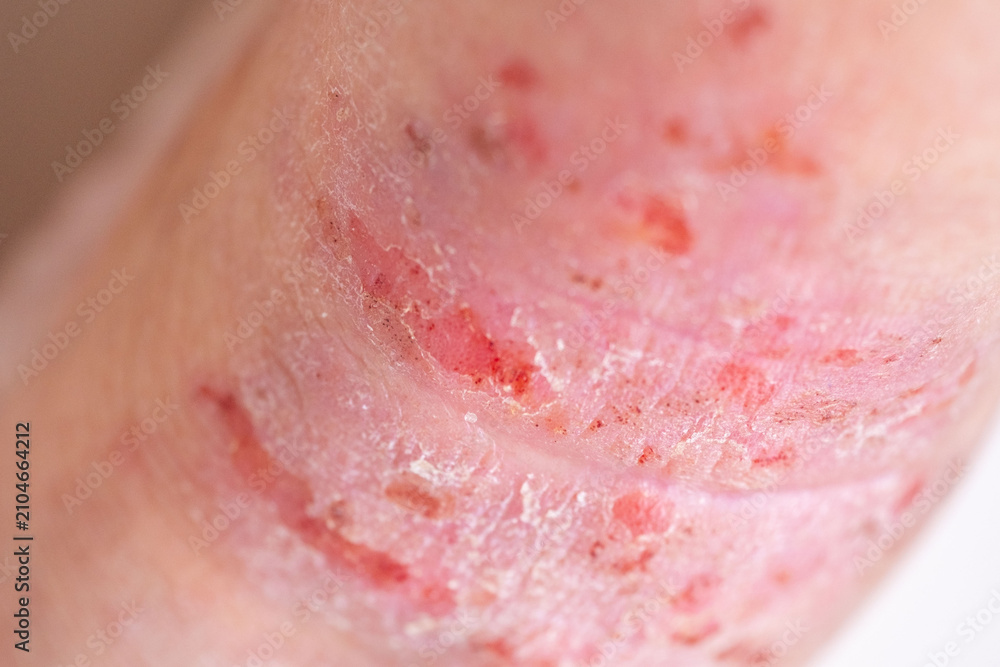 Fototapeta premium dermatitis allergic reactions, itchy skin on leg, closeup injured female limb damaged reddened skin scratches, wound on painful female leg, chronic dermatological disorder, skin problem, affected area