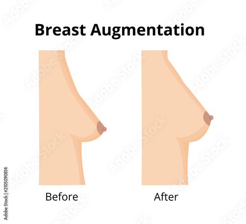 Breast augmentation before after contrast showing surgery results