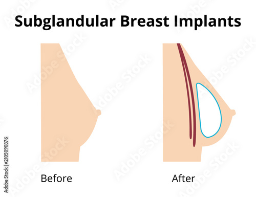 Subglandular breast implants placement before and after comparison