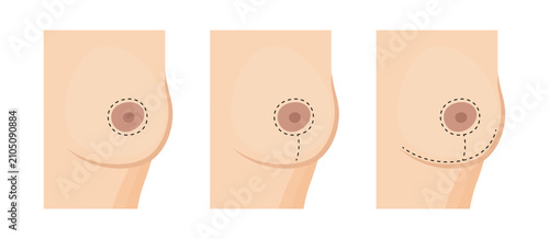 Breast lift mastopexy and reduction mammoplasty incision marking