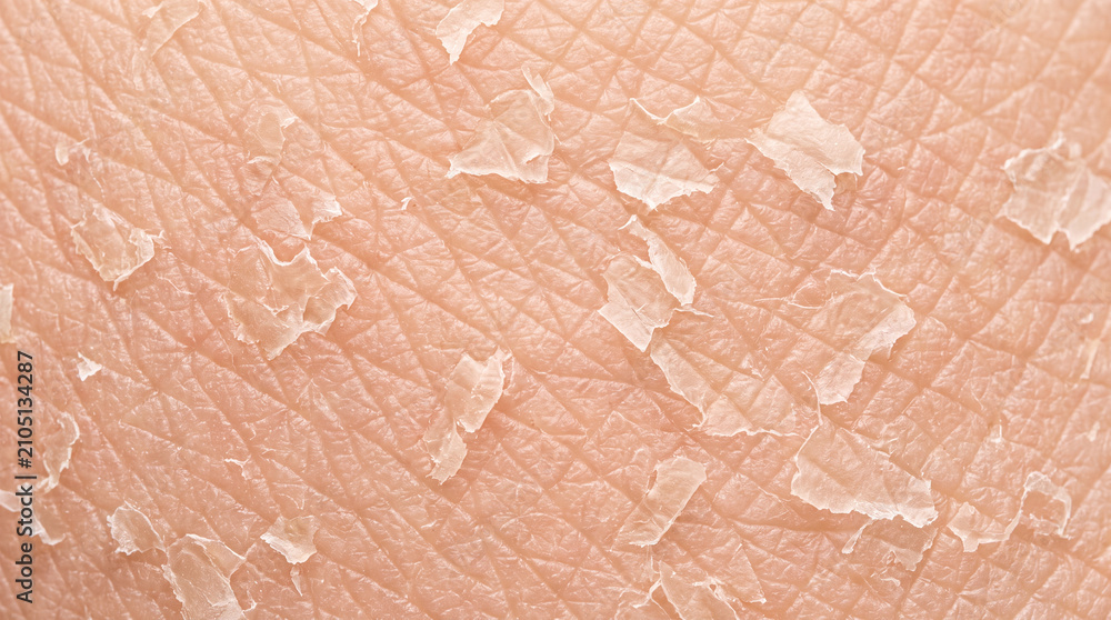 Fototapeta premium Dry skin peeling skin texture closeup flaky dehydration macro view of dry peeling skin texture, flaky surface with dehydration