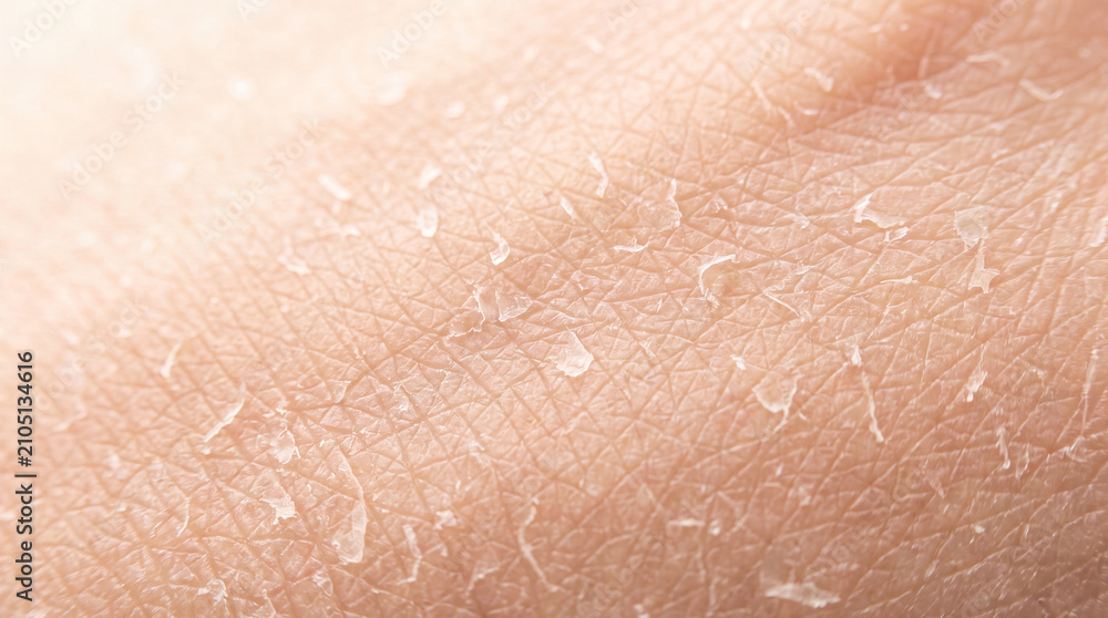 Fototapeta premium Dry skin skin peeling flake texture dermatitis close up human skin with peeling flake and rough texture, skincare concern