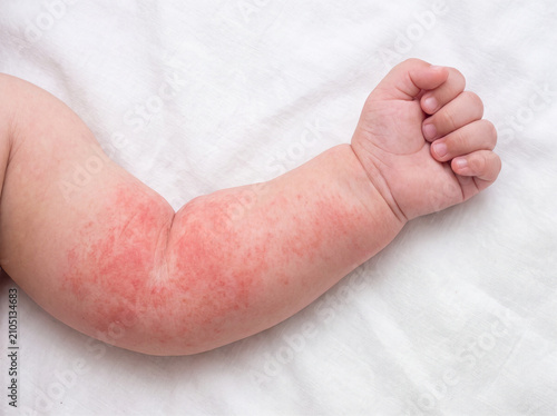 Baby arm rash eczema allergy skin infant arm with red rash and irritated skin white bedding, healthcare concept, concern mood