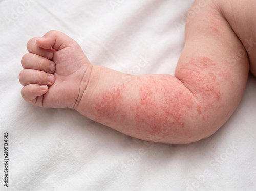 Baby arm rash eczema dermatitis skin
