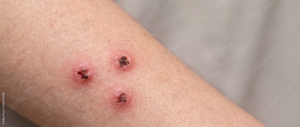 Fototapeta premium Close up view of infected red insect bites on human arm skin