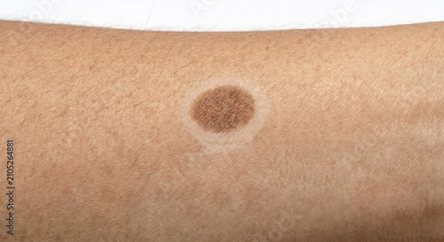 Foto Macule with Surrounding Halo - - Macule on Human Skin — Macule Plate (79-90)