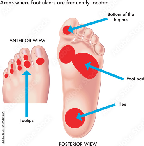 Medical illustration of areas where foot ulcers are frequently located.