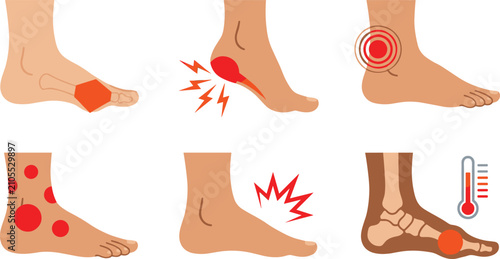 Fotografia Foot and Ankle Pain Symptoms Vector Illustration Set Featuring Plantar Fasciitis