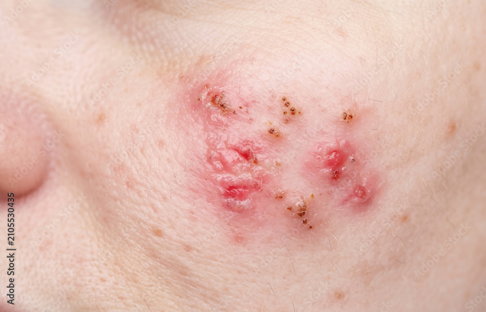 Fototapeta premium Herpes Simplex Infection on Female Cheek, Cluster of Vesicles and Scabs on Face Close Up